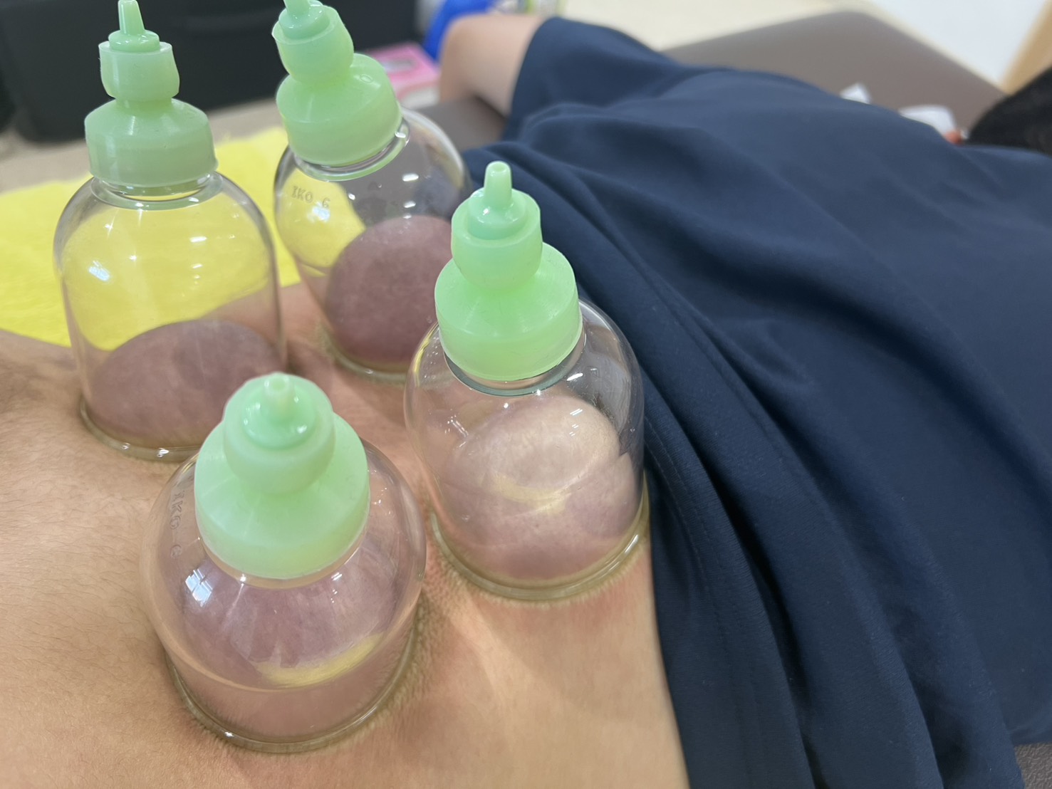 カッピング写真